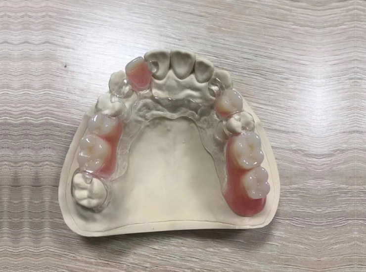 Acrylic Denture 2